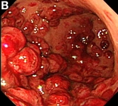 Bağırsak Kanaması Belirtileri ve Tedavisi
