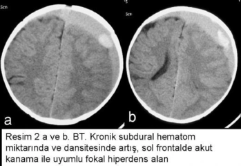 Subdural Kanama Belirtileri ve Tedavisi