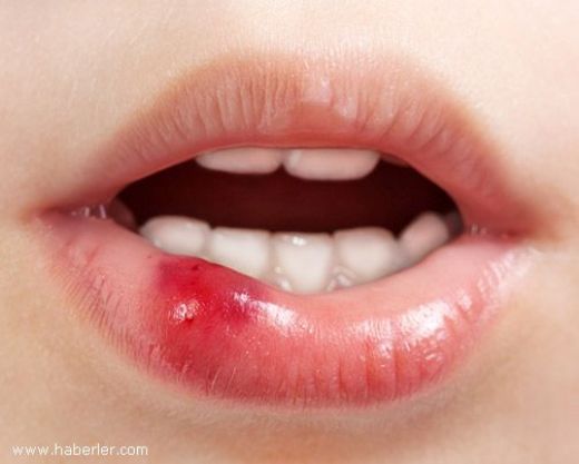 Dudak Kanaması Belirtileri ve Tedavisi