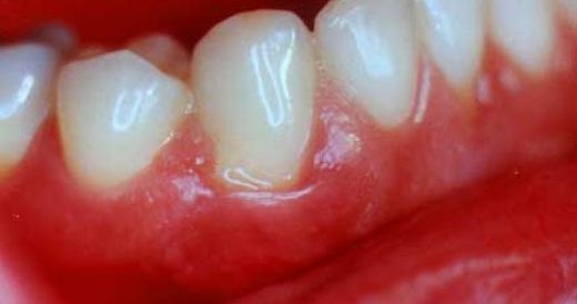 Durduk Yere Diş Eti Kanaması Belirtileri ve Tedavisi