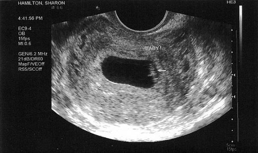 Gebeliğin 5 Haftasında Kanama Nedenleri?