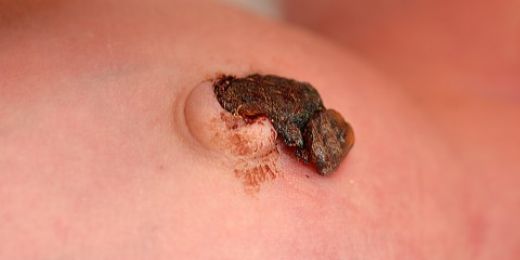 Göbek Bağı Kanaması Belirtileri ve Tedavisi