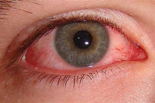 Göz Kanaması Belirtileri ve Tedavisi