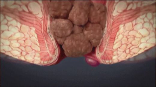 Hemoroid Kanaması Belirtileri ve Tedavisi