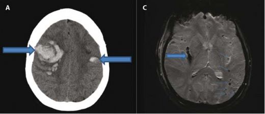 İntraserebral Kanama Belirtileri ve Tedavisi