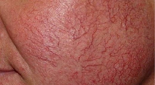 Kılcal Damar Kanaması Belirtileri ve Tedavisi