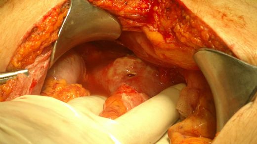 Mide Kanaması Ameliyatı Riskleri ve Sonrası