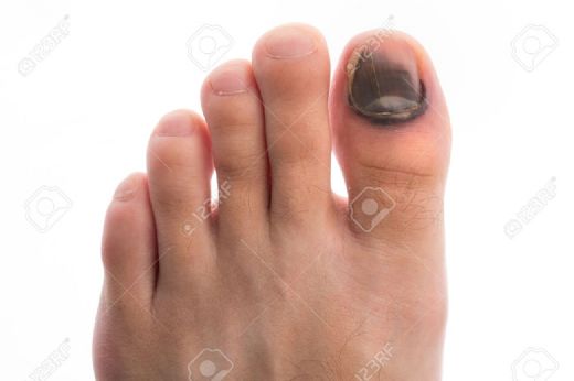 Tırnak Altı Kanaması Belirtileri ve Tedavisi