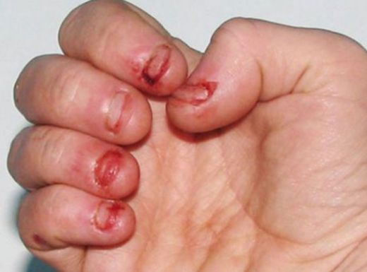 Tırnak Kanaması Belirtileri ve Tedavisi