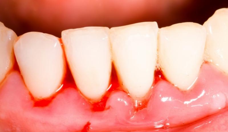 Diş Kanaması Orucu Bozar mı?